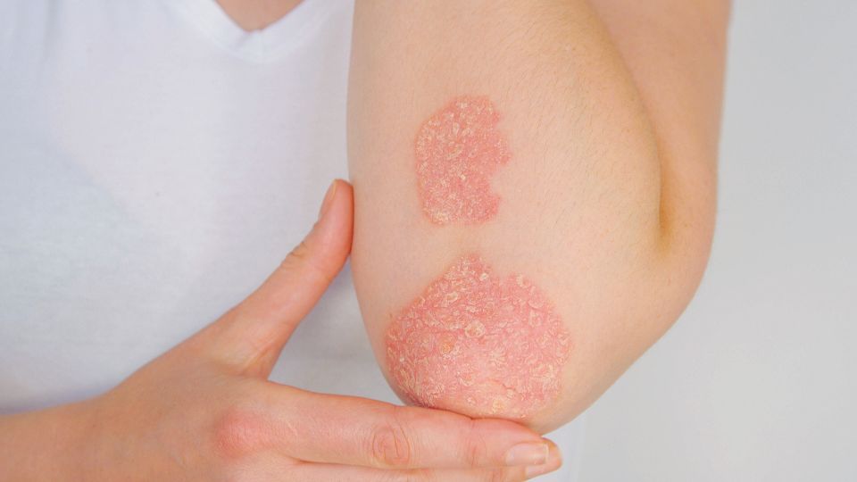 Causas de la psoriasis y factores de riesgo en la mujer Causas de la psoriasis y factores de riesgo en la mujer.