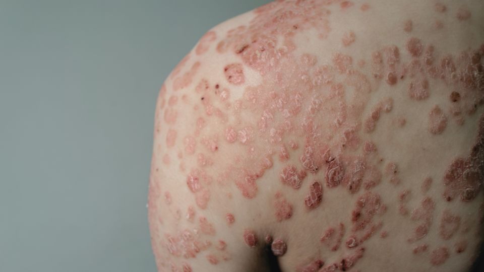 Factores de riesgo, causas y síntomas de la psoriasis infantil Factores de riesgo, causas y síntomas de la psoriasis infantil.