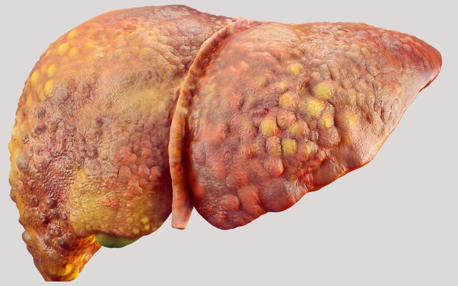 El consumo excesivo de alcohol puede dañar al hígado y perjudicar la efectividad de los tratamientos para la psoriasis. El consumo excesivo de alcohol puede dañar al hígado y perjudicar la efectividad de los tratamientos para la psoriasis.