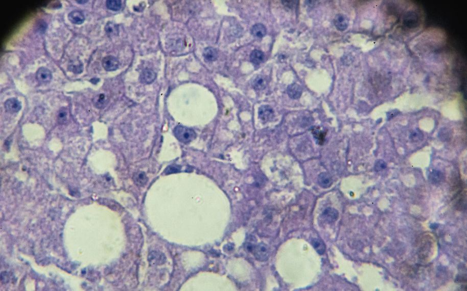 Cómo se minimiza el riesgo de aparición de hígado graso en personas con psoriasis Cómo se minimiza el riesgo de aparición de hígado graso en personas con psoriasis