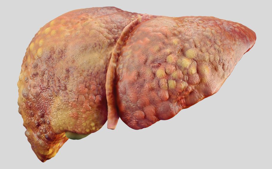 Why is psoriasis associated with a higher risk of fatty liver disease?