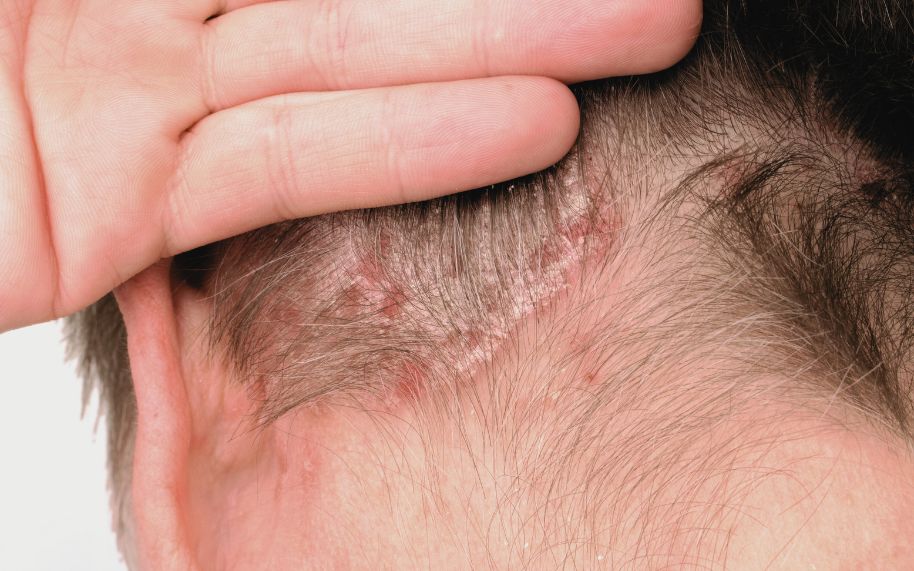 Psoriasis en cuero cabelludo con placas y posible caída de cabello