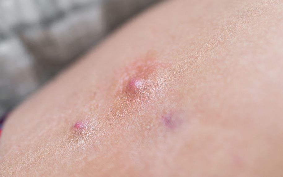 Qué entendemos realmente por una hidradenitis mal controlada Qué entendemos realmente por una hidradenitis mal controlada