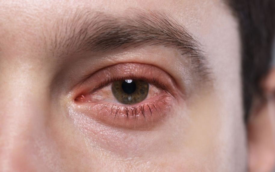 La psoriasis se relación con diferentes problemas oculares La psoriasis se relación con diferentes problemas oculares