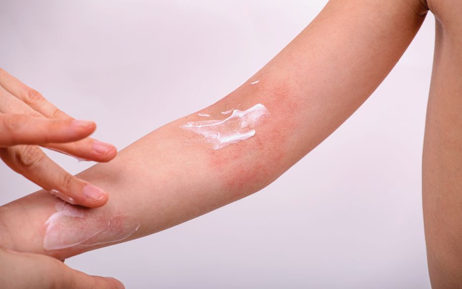 Padre cuidando a un niño con dermatitis atópica y brotes frecuentes en la piel Padre cuidando a un niño con dermatitis atópica y brotes frecuentes en la piel