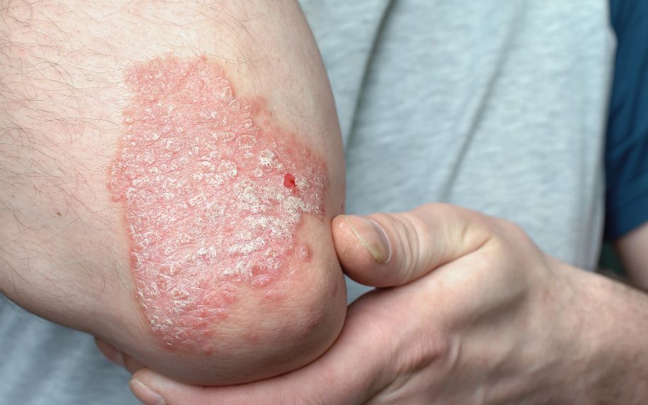 Persona con psoriasis mal controlada y recaídas pese a tratamientos tópicos Persona con psoriasis mal controlada y recaídas pese a tratamientos tópicos