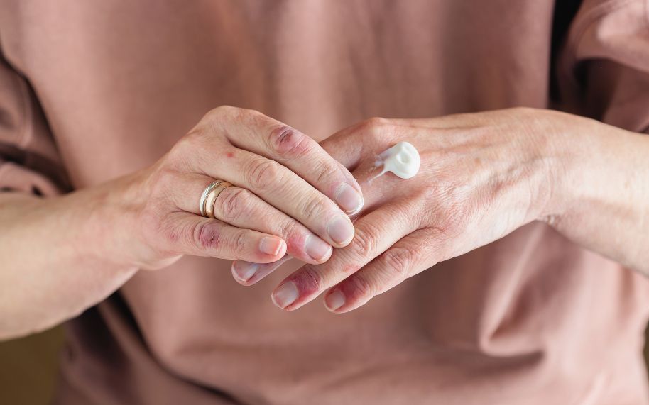 Señales de que la dermatitis atópica está mal controlada Señales de que la dermatitis atópica está mal controlada