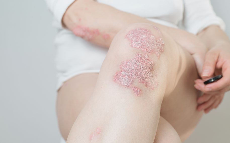 Los tratamientos avanzados para la psoriasis no son solo para los casos graves.
