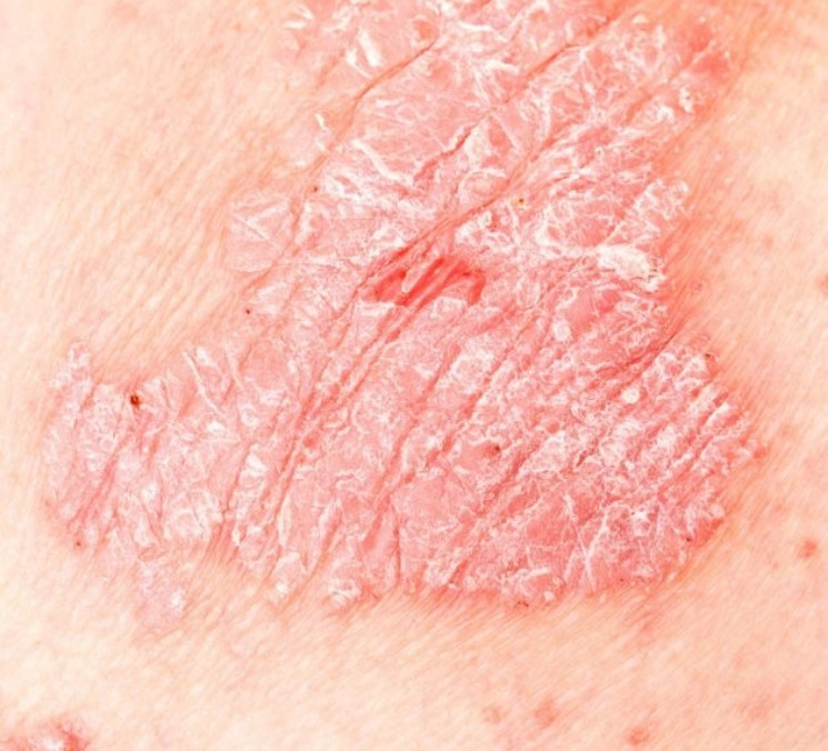 Dermatólogo especialista en psoriasis en Madrid (España) Dermatólogo especialista en psoriasis en Madrid (España)