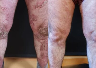 Skin response and reduction in psoriasis plaques following specialist-led biological therapy