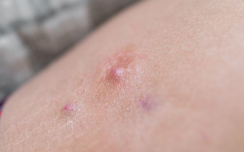 Hidradenitis suppurativa treatment in Spain (Madrid) Hidradenitis suppurativa treatment in Spain (Madrid)